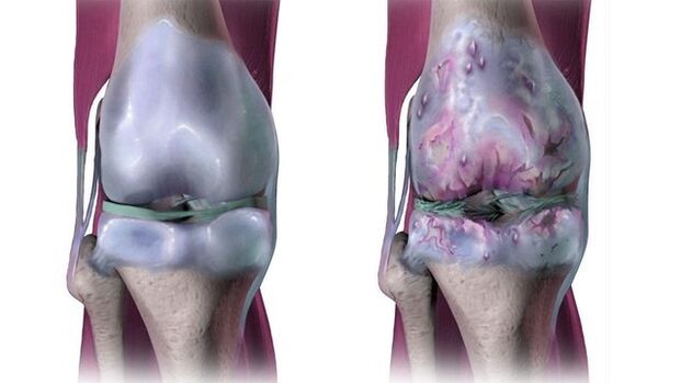 Articulation du genou saine et affectée par l'arthrose