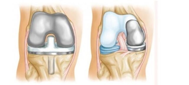 arthroplastie pour arthrose de l'articulation du genou