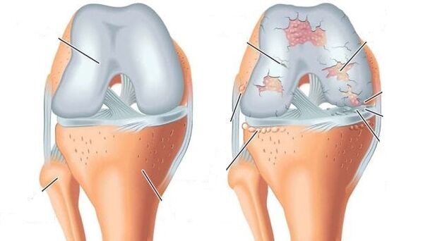articulation saine et arthrose de l'articulation du genou