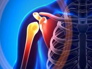 Articulation de l'épaule enflammée due à l'arthrose - une maladie chronique du système musculo-squelettique