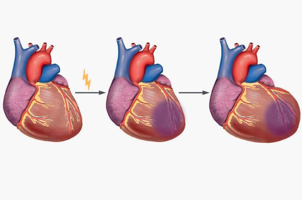 L'infarctus du myocarde entraîne des douleurs dans les omoplates