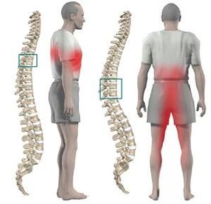 Une douleur à la chondose thoracique peut être donnée aux membres inférieurs et à l'entrejambe