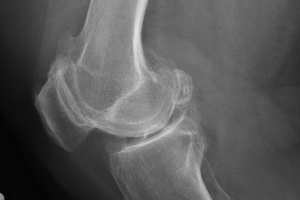 Méthodes de diagnostic de l'arthrose du genou