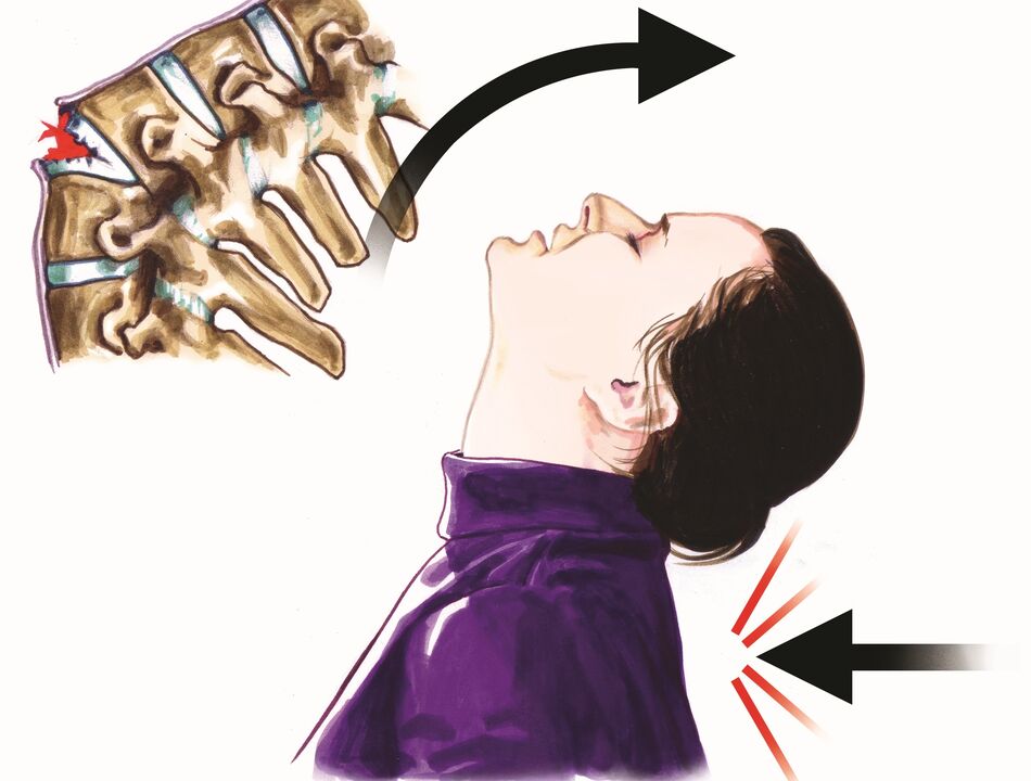 lésions de la colonne vertébrale comme cause de douleurs au cou